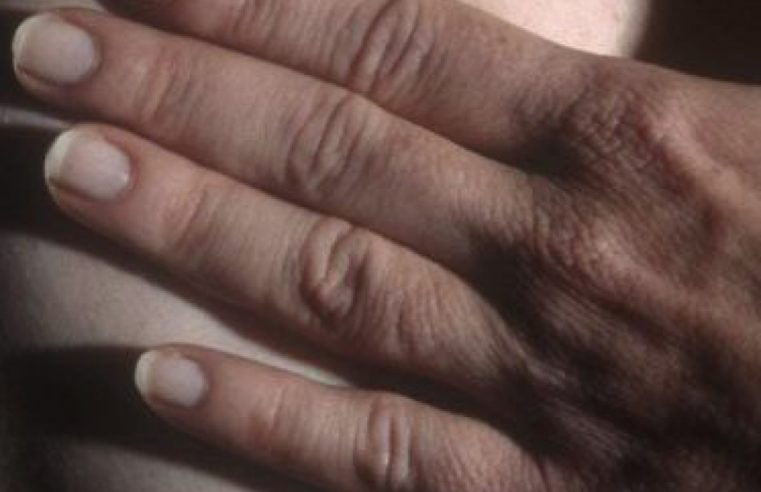 Pandemia reduz exames de mama no SUS em 62%, diz pesquisa