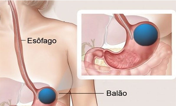 Balão de engolir: uma técnica inovadora e menos invasiva para tratar a obesidade está disponível no Brasil