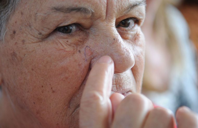 Pandemia dificulta diagnóstico precoce de câncer de pele, diz SBD