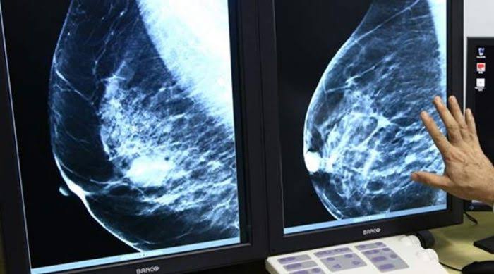 A falta de uma peça (dosímetro), no mamógrafo, impede a realização de mamografias no Centro de Saúde em Petrópolis
