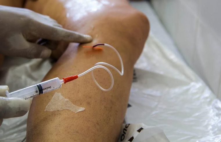 Pandemia fez cirurgias de varizes pelo SUS despencarem 69% no país