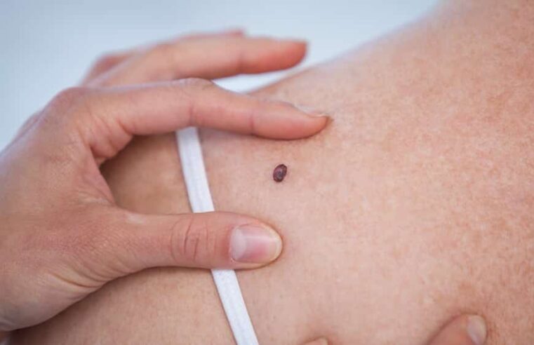 Câncer de pele não melanoma é o mais comum no Brasil