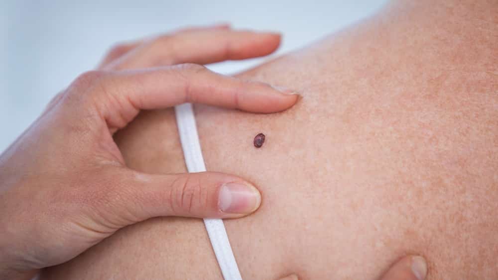 Câncer de pele não melanoma é o mais comum no Brasil