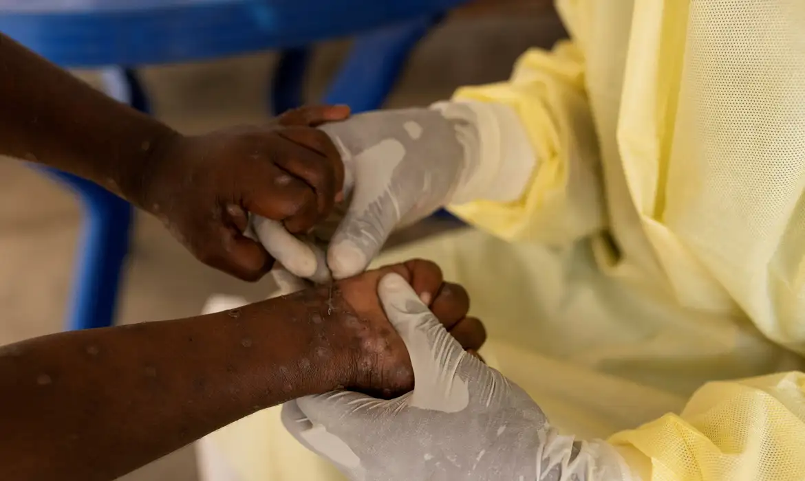 Mpox: OMS aprova primeira vacina para uso emergencial em crianças
