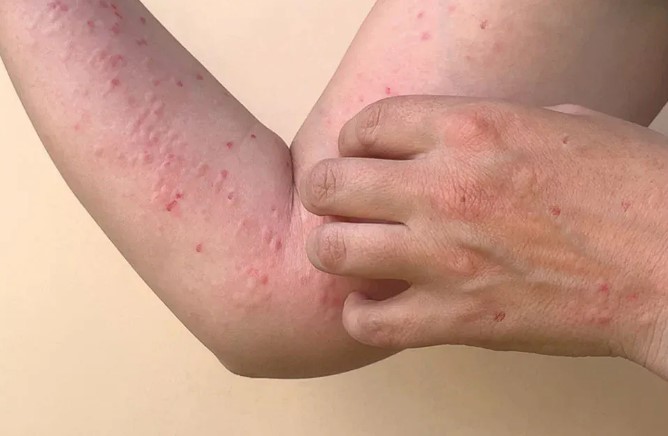 OMS avalia se mpox deve voltar a ser declarada emergência global